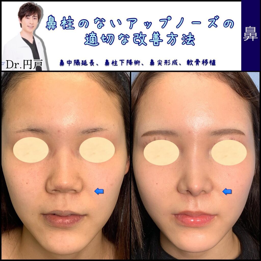 鼻尖形成の症例写真 (1)