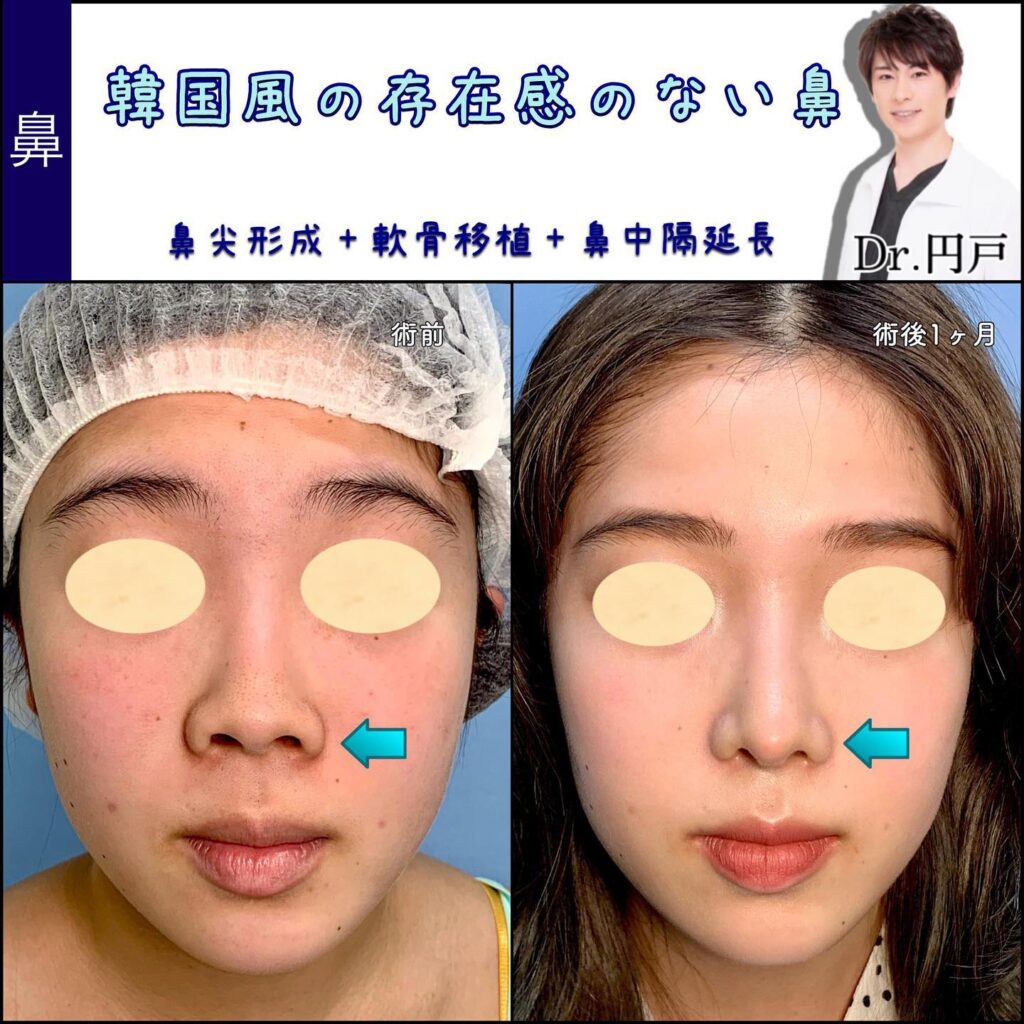 富山院の鼻整形の症例 (10)