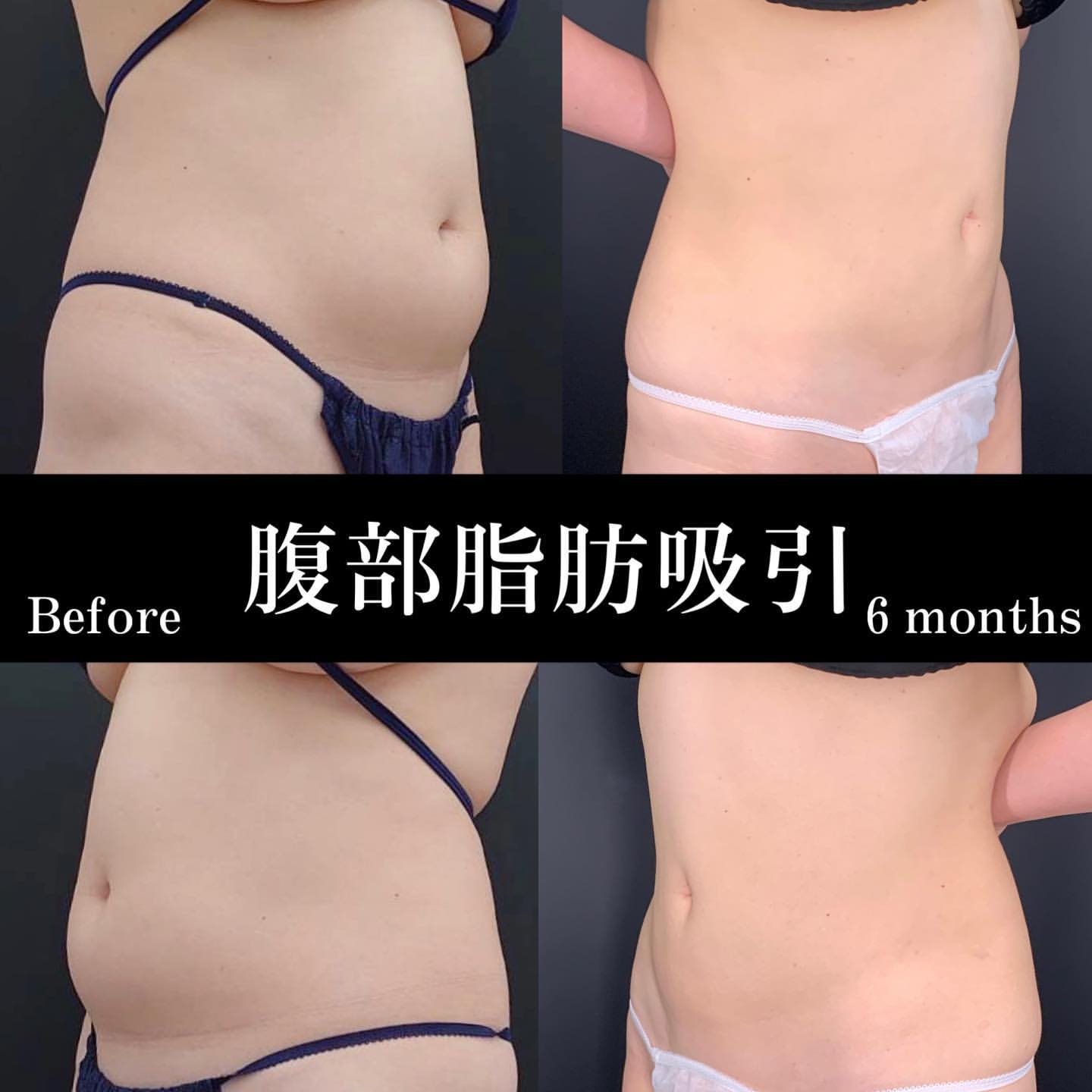 脂肪吸引の施術一覧 | eスキン＆eクリニック富山院【公式】｜美容整形