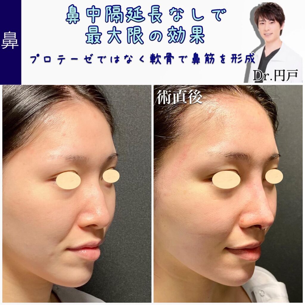 富山院の鼻整形の症例 (1)