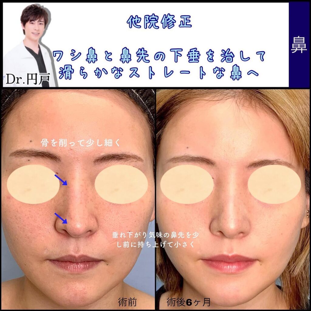 富山院の鼻整形の症例 (4)