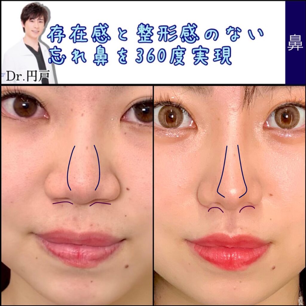 富山院の鼻整形の症例 (3)