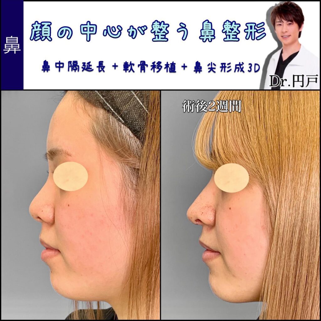 鼻尖形成３D法の症例写真