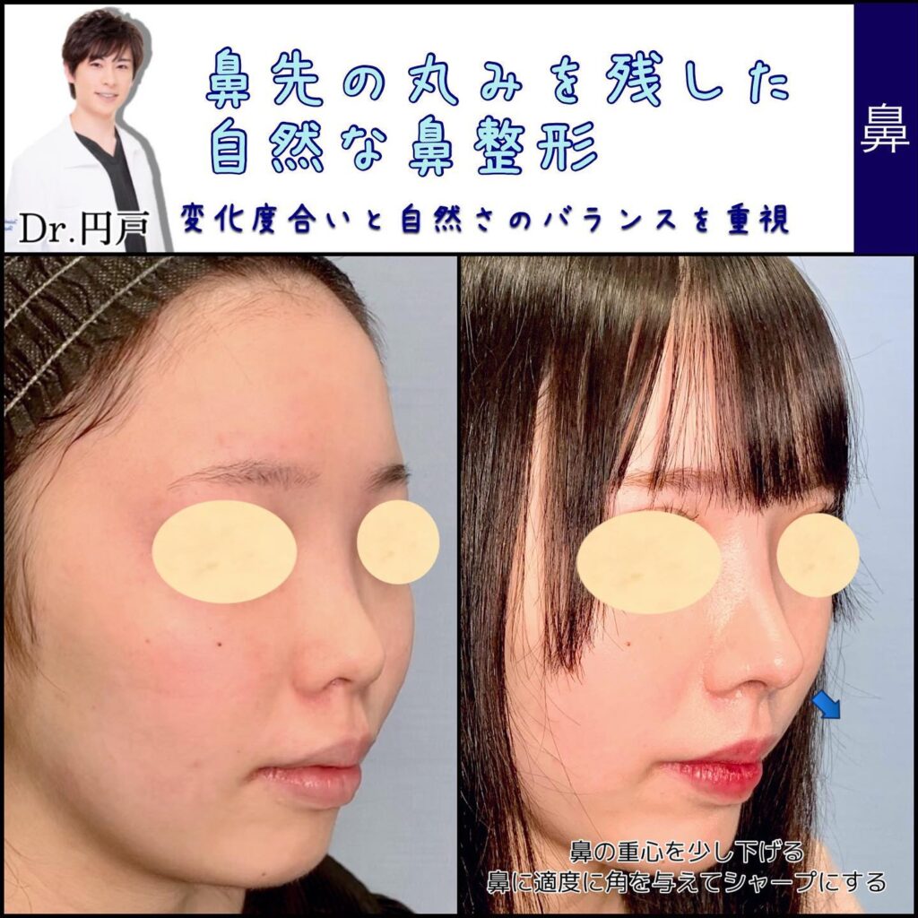 富山院の鼻整形の症例 (5)