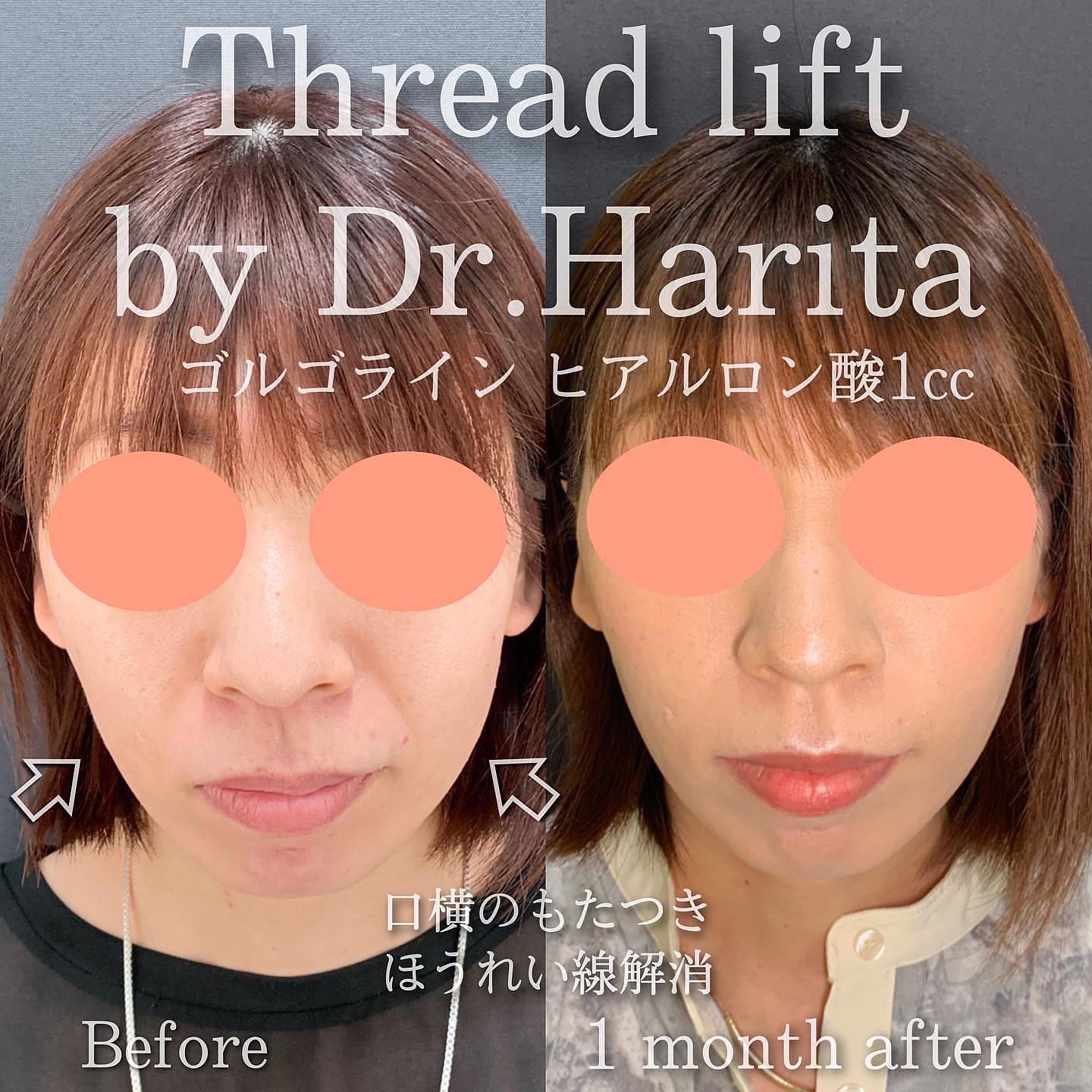 Thread Lift by Dr.Harita