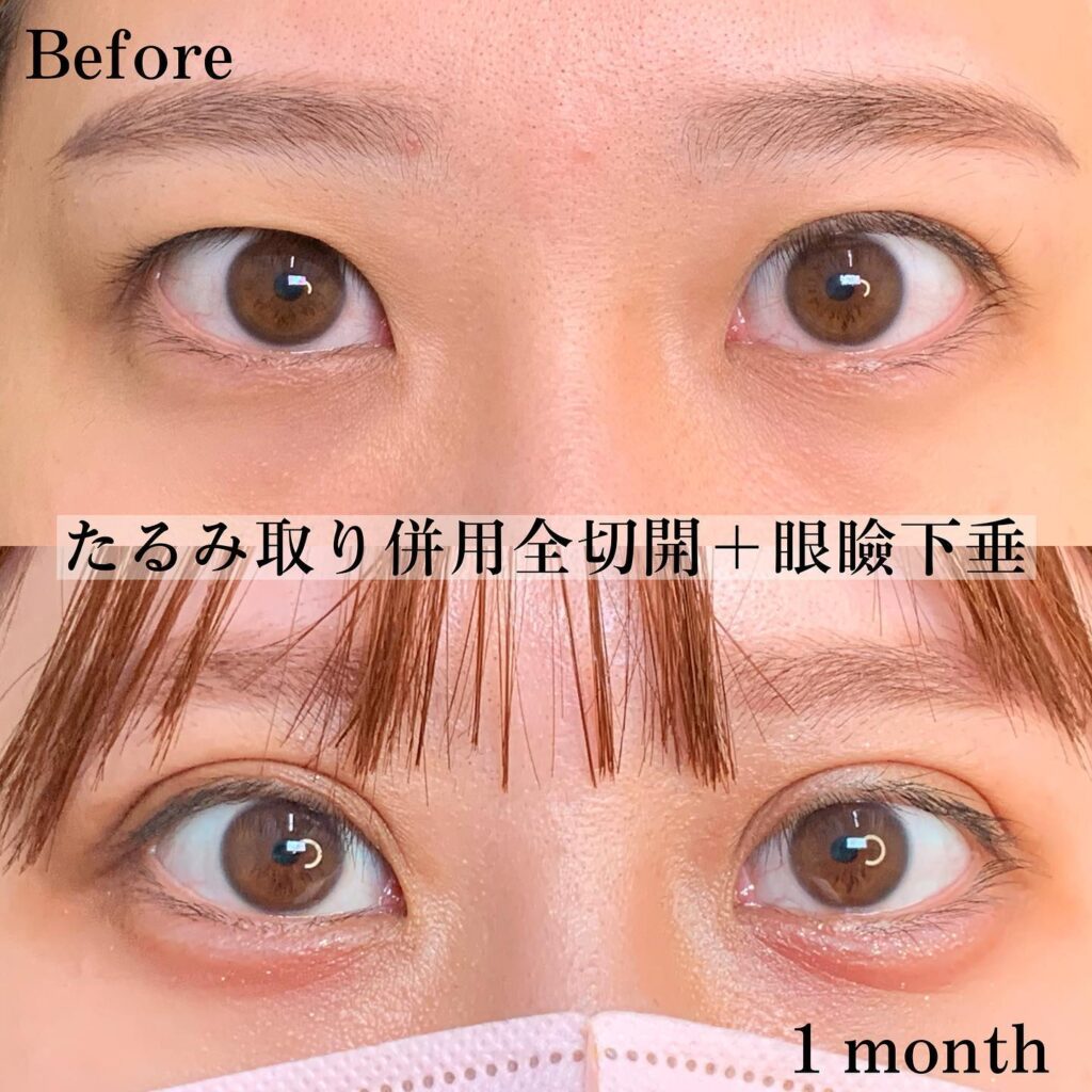 富山院で行った「たるみ取り併用全切開」と「眼瞼下垂」の20代の女性の症例