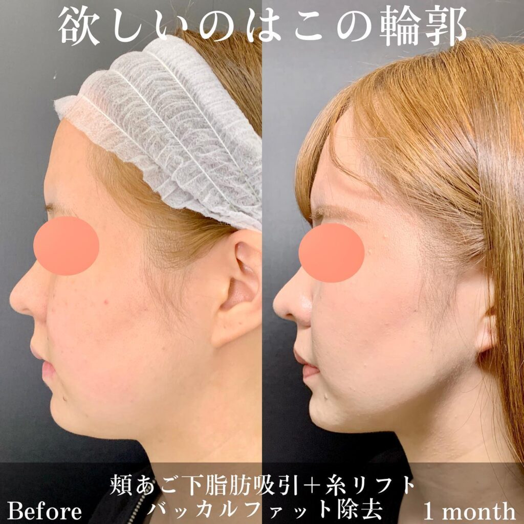 糸リフトと顔の脂肪吸引の１か月後の症例