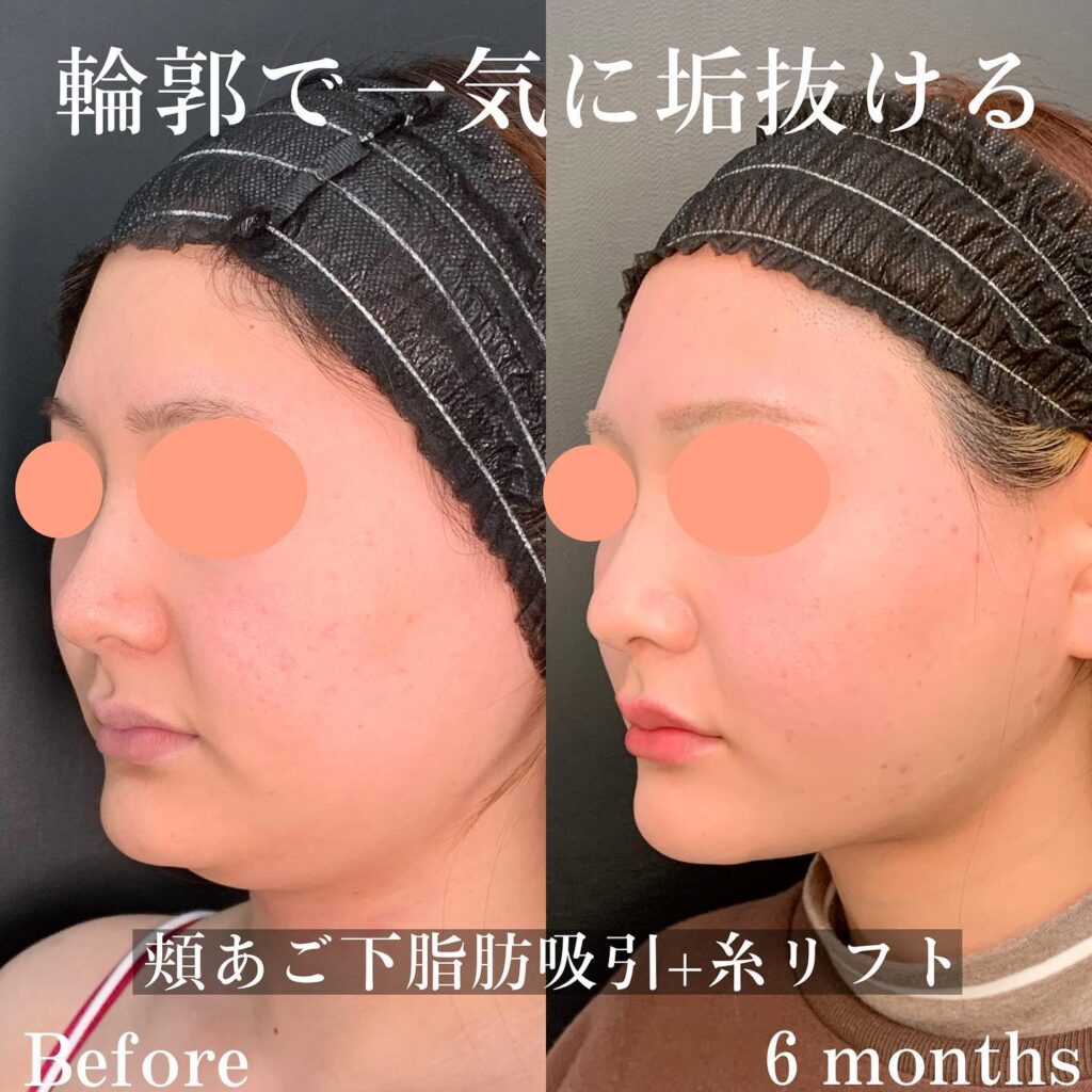 富山院で行った糸リフトと頬と顎下の脂肪吸引した６ヶ月後の斜めから見た症例