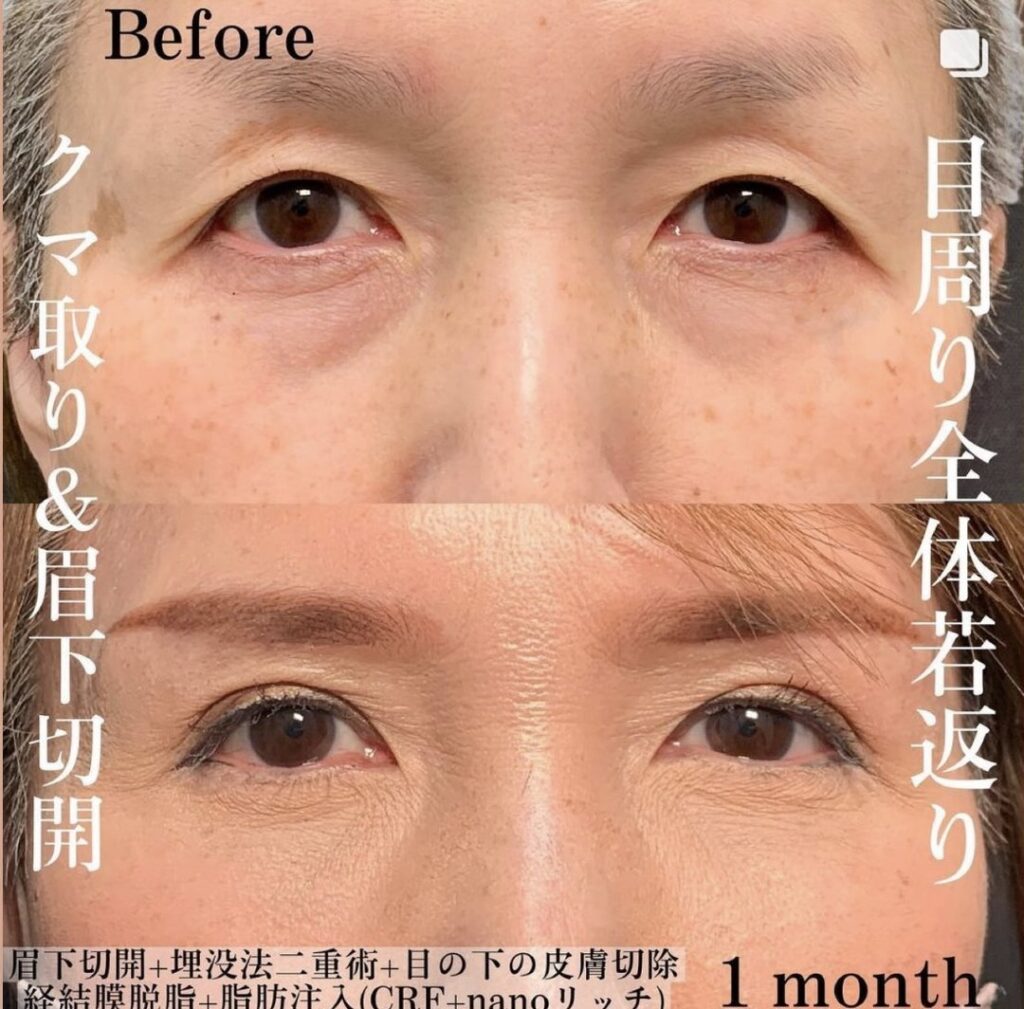 富山院の眉下切開の症例