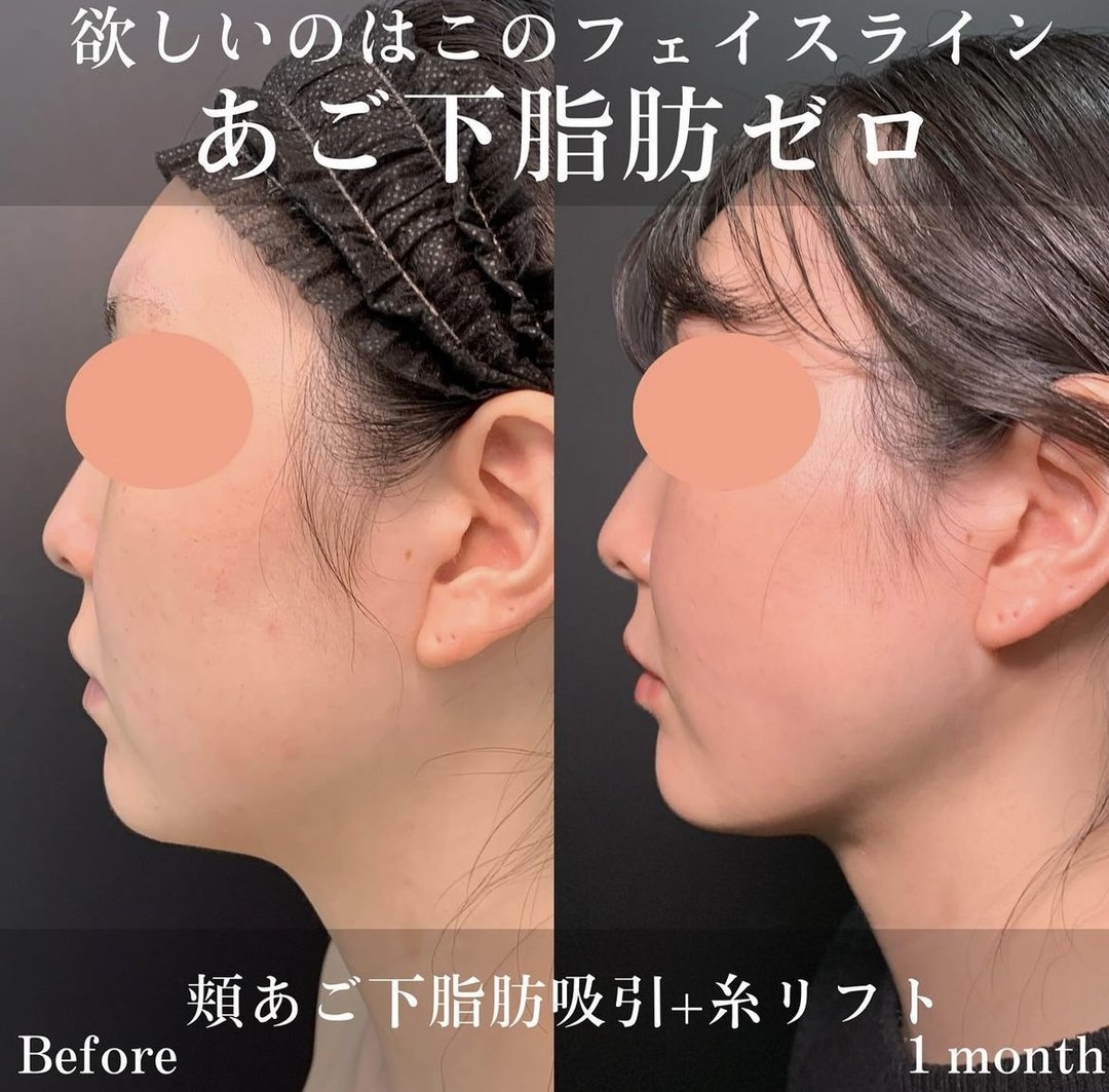 富山院の顎下の脂肪吸引と糸リフトの症例