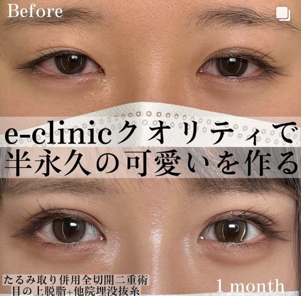 富山院の二重切開と目の上の脱脂の症例