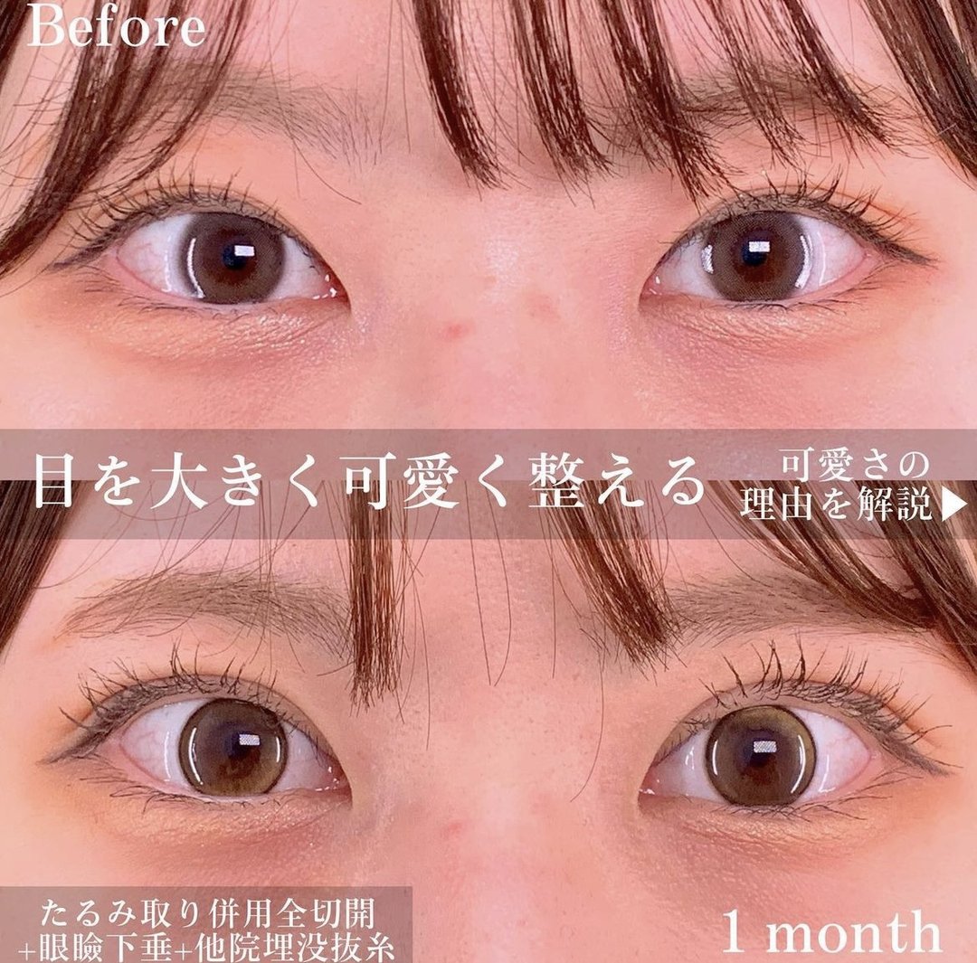 富山院の二重切開と眼瞼下垂の症例