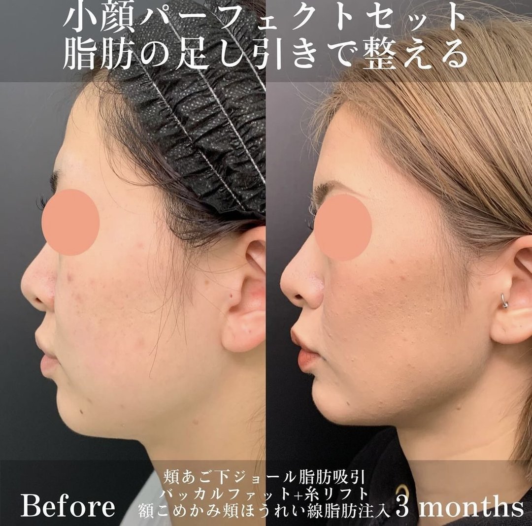 富山院の顎下の脂肪吸引とバッカルファット除去と糸リフトの症例