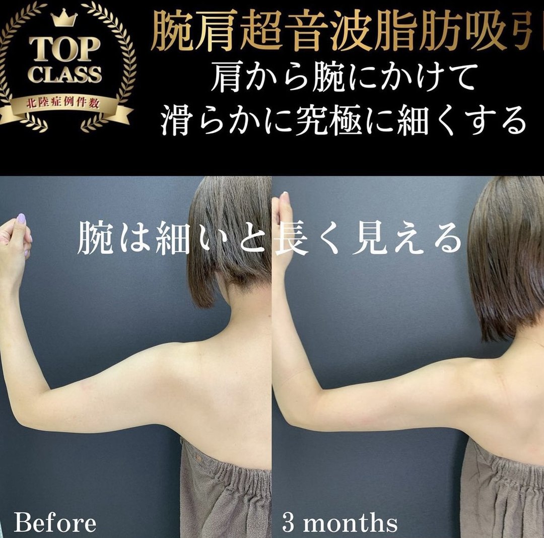 富山院の二の腕の脂肪吸引の症例