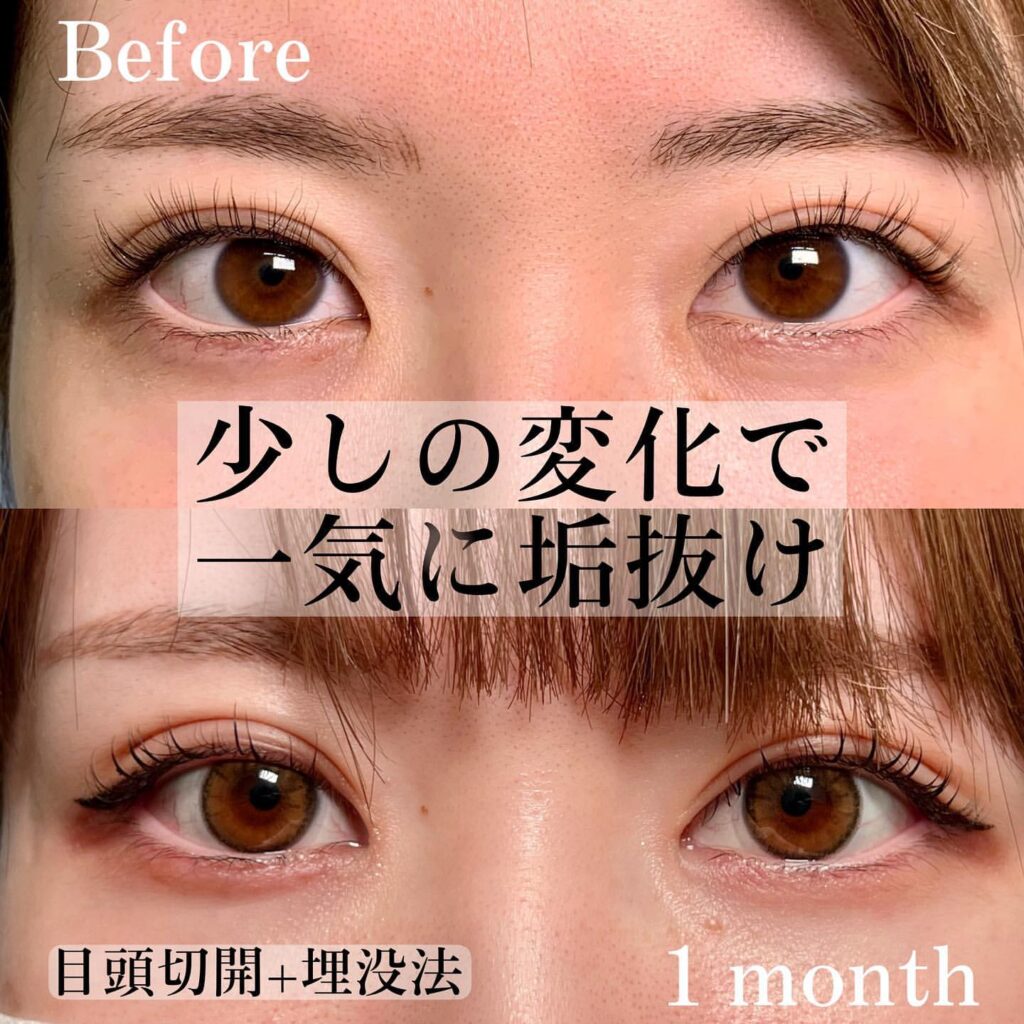 目頭切開と埋没法の症例写真 (2)