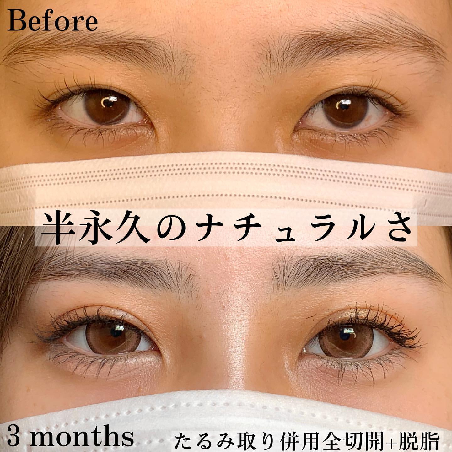 eクリニック富山院のたるみ取り併用全切開と脱脂の症例写真（名医の張田医修平師が執刀）