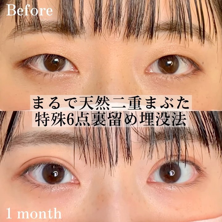 eクリニック富山院の埋没法（名医の張田修平医師が執刀）