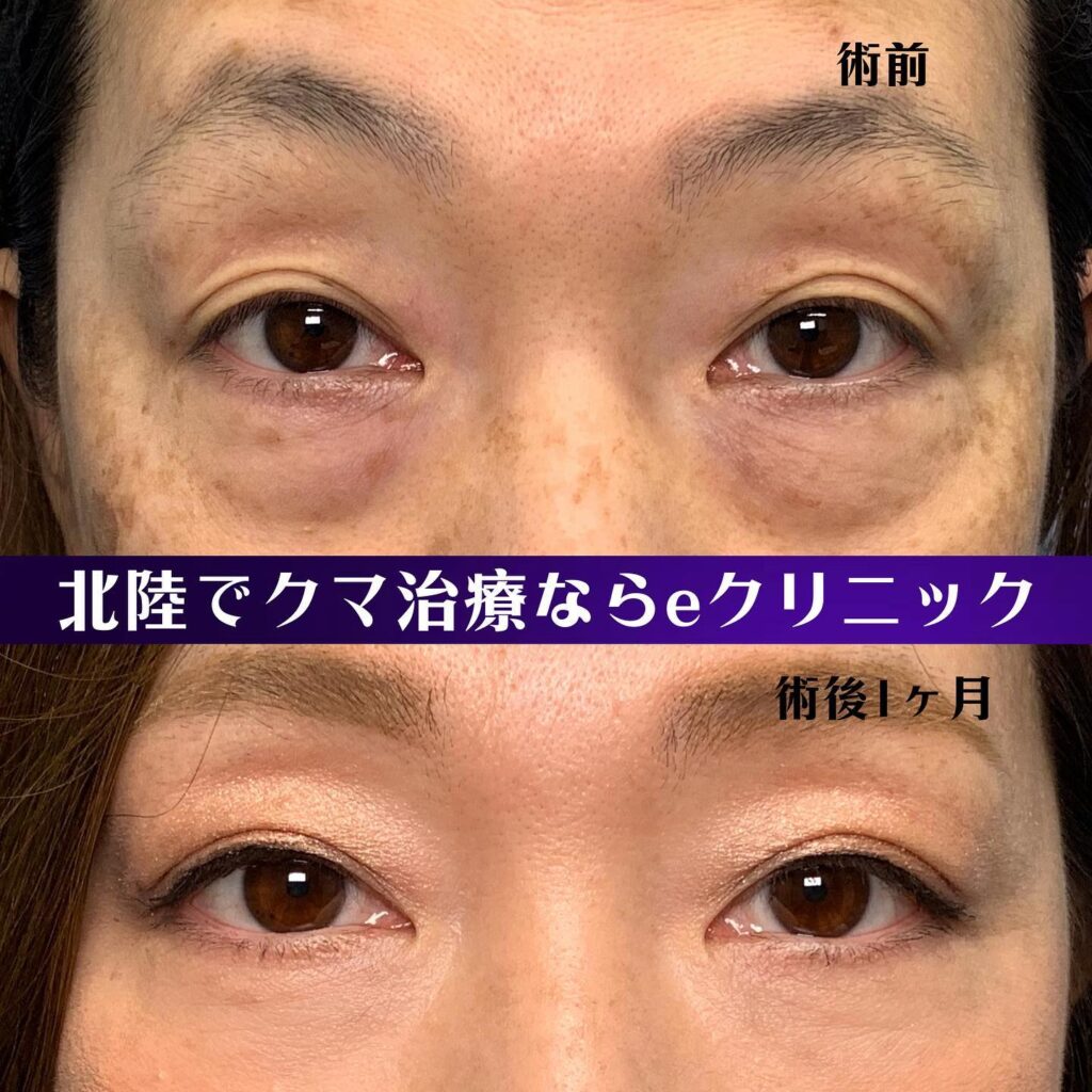 目の下のクマ取りの症例写真 (7)