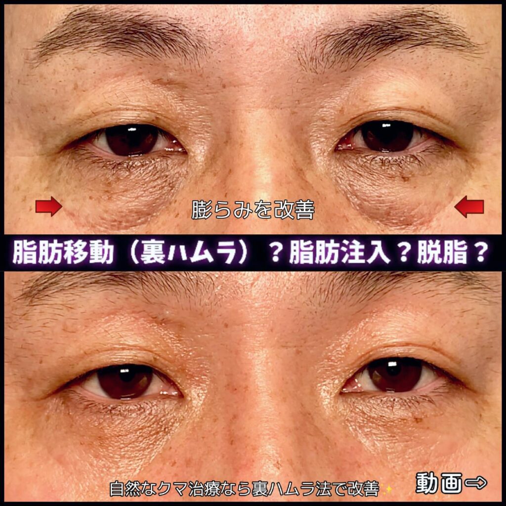 目の下のクマ取りの症例写真 (5)