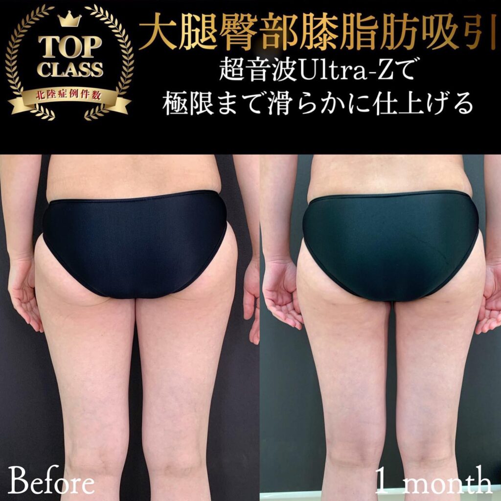 太ももの脂肪吸引の症例写真 (16)