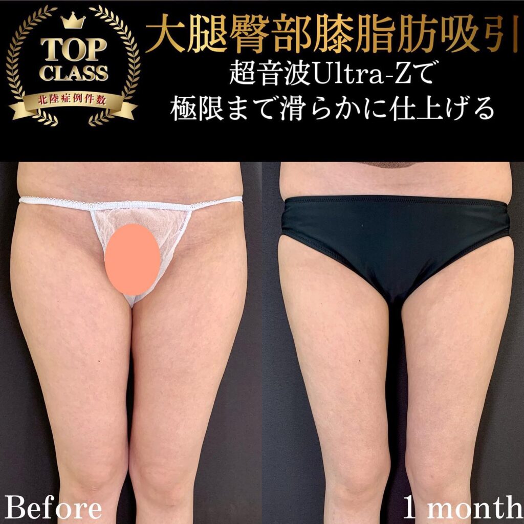 太ももの脂肪吸引の症例写真 (10)