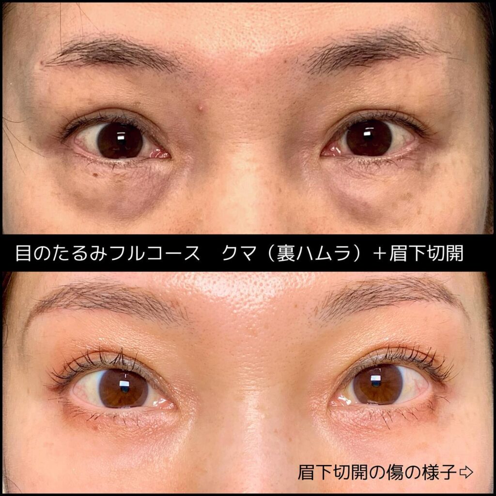 裏ハムラ法と眉下切開の症例写真
