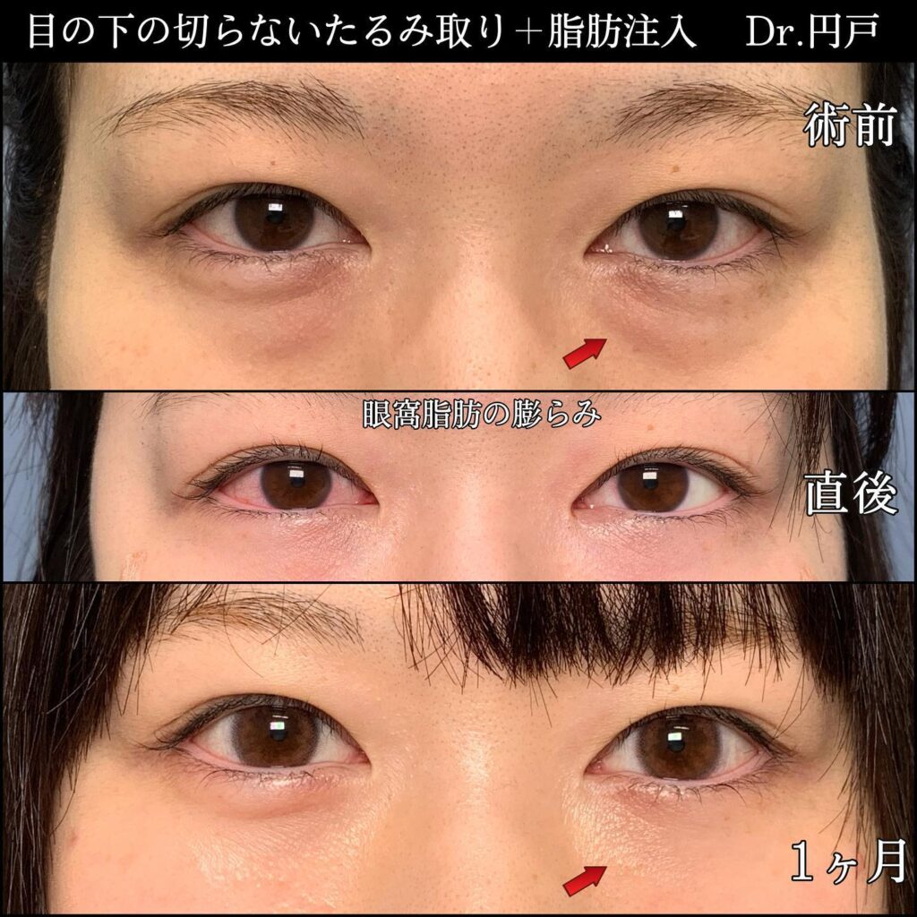 切らない目の下のたるみ取りと脂肪注入の症例写真 (2)