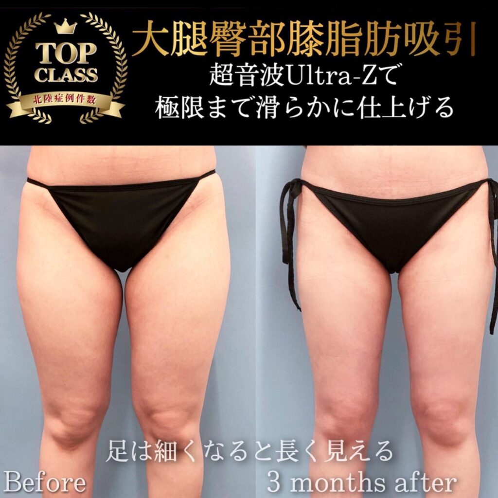 太ももの脂肪吸引の症例写真 (13)