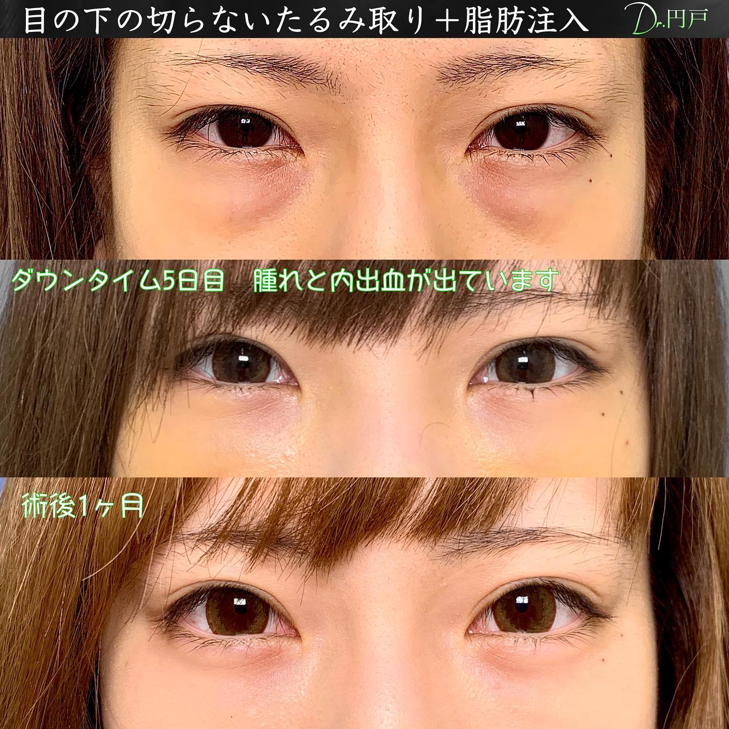 切らない目の下のたるみ取りと脂肪注入の症例写真