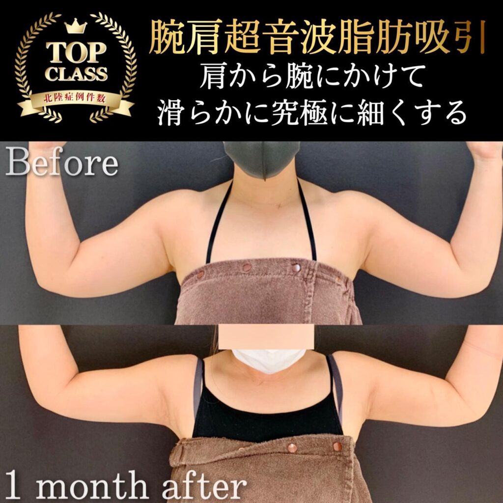 腕肩の脂肪吸引の症例写真 (5)