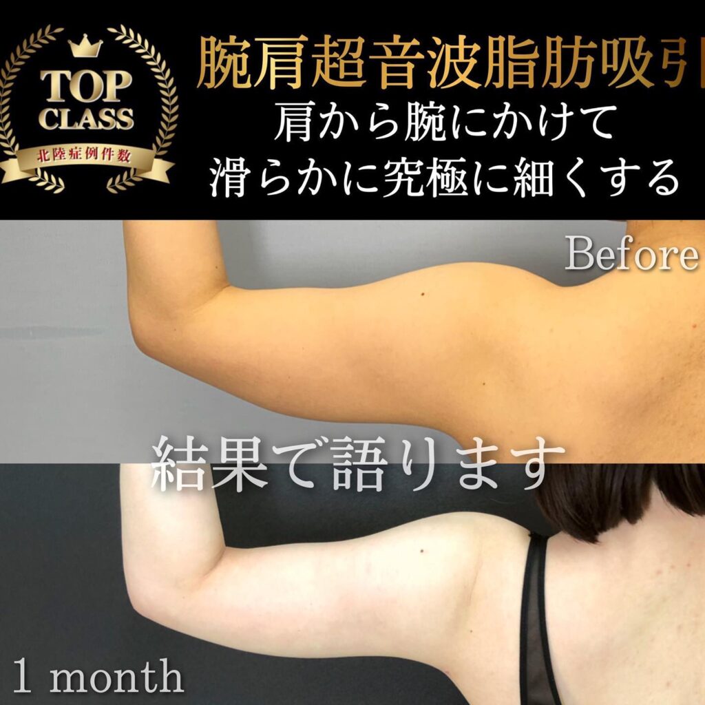 腕肩の脂肪吸引の症例写真 (6)