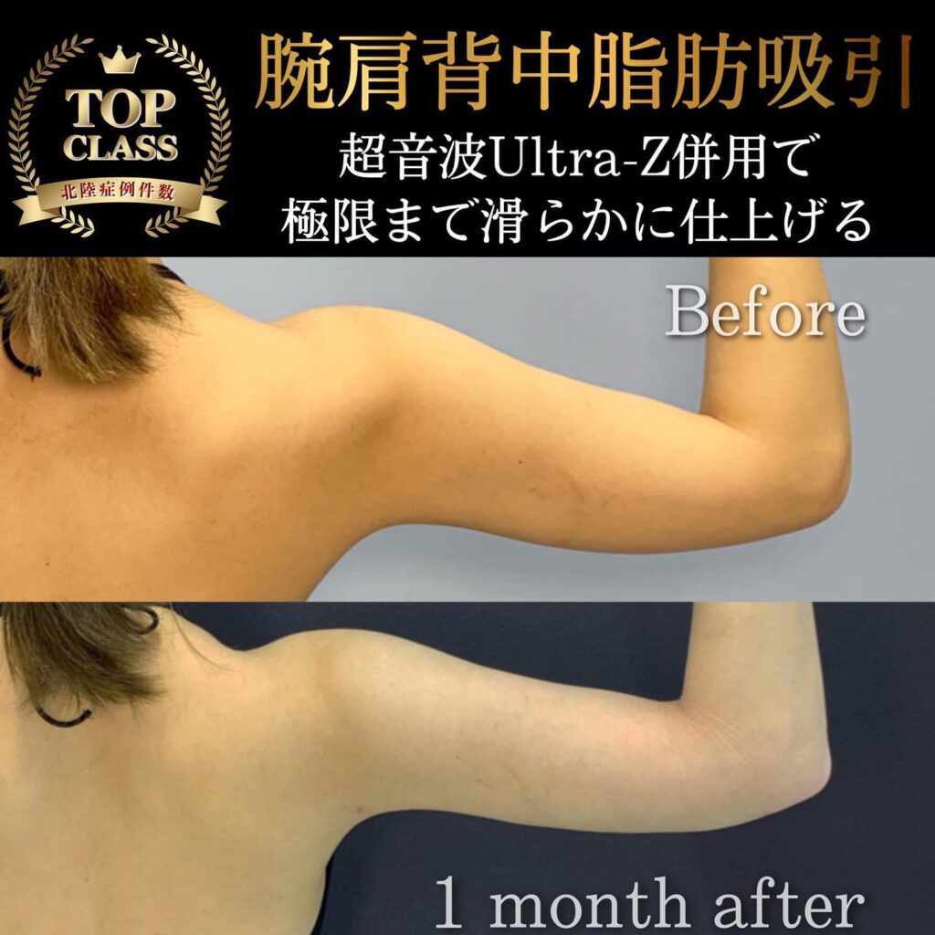 腕肩の脂肪吸引の症例写真 (4)