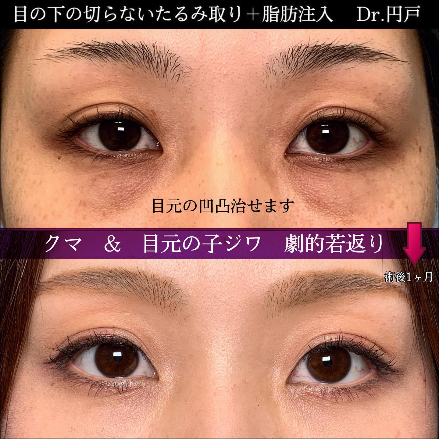 切らない目の下のたるみ取りと脂肪注入の症例写真 (3)
