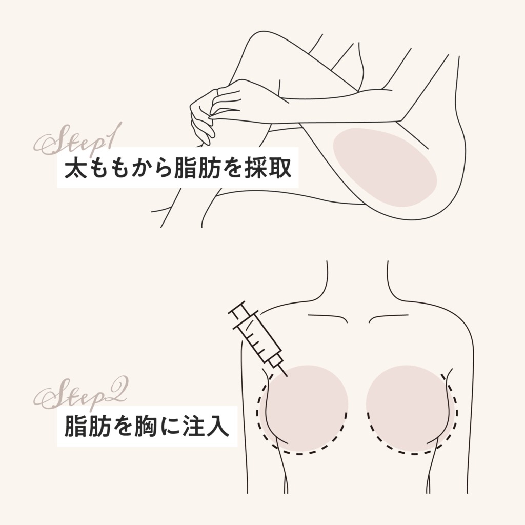 ふんわりバスト注射の流れ