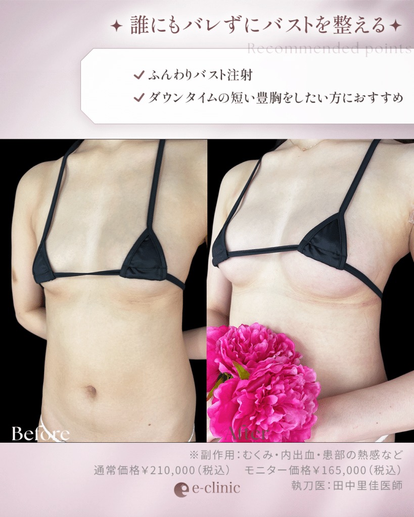 ふんわりバスト注射の症例写真 (1)