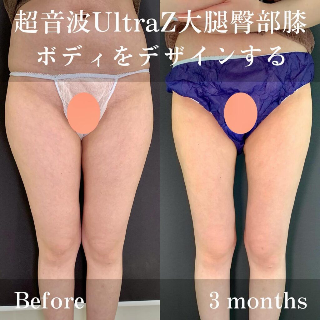 太ももの脂肪吸引の症例写真
