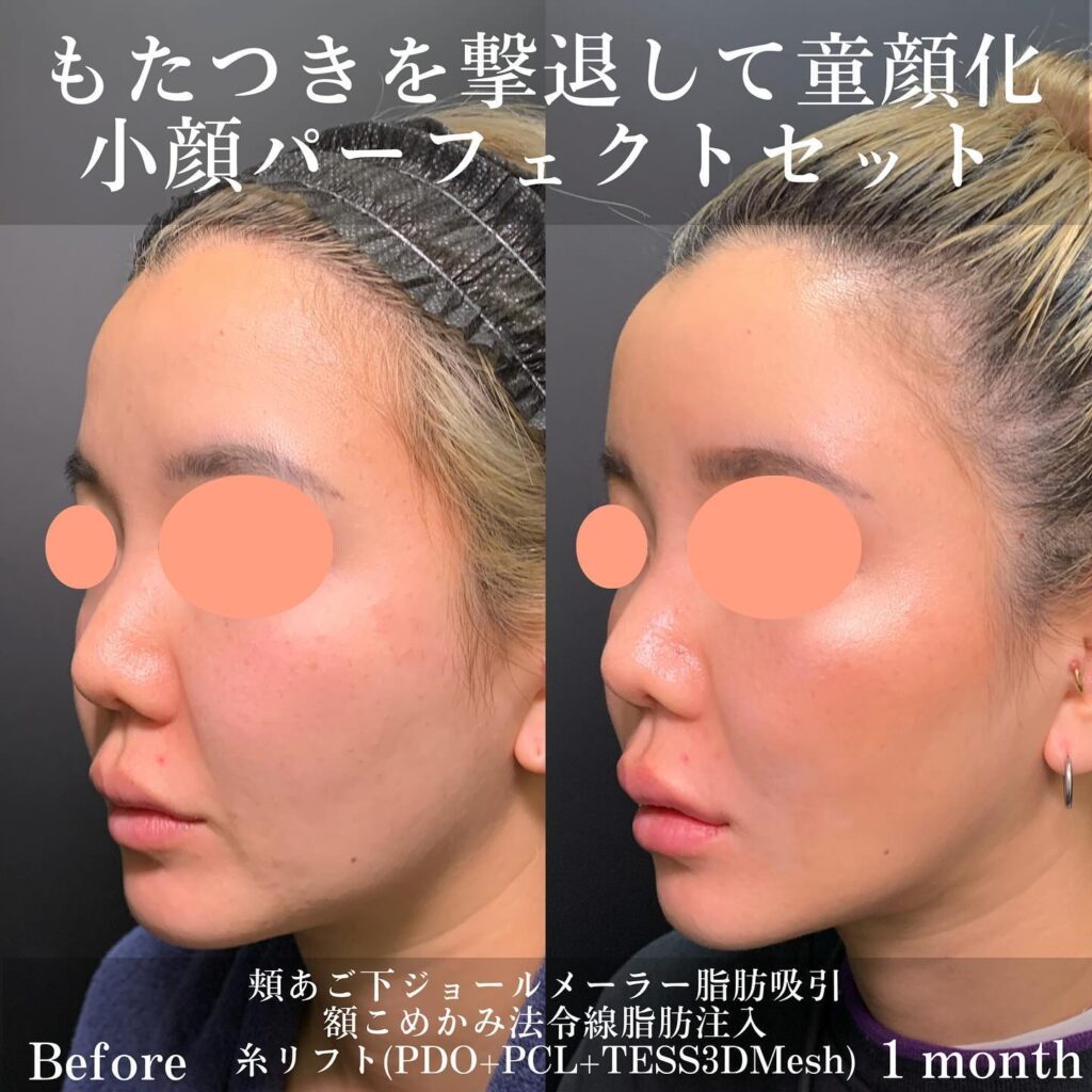 ジョールファットとメーラーファットと脂肪注入と糸リフトの症例写真 (2)