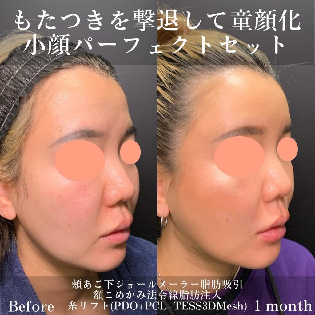 ジョールファットとメーラーファットと脂肪注入と糸リフトの症例写真 (1)