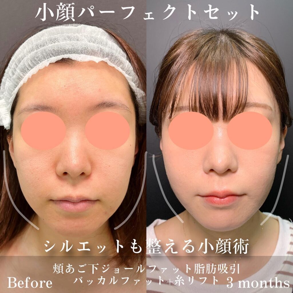 ジョールファットとバッカルファットと糸リフトの症例写真 (1)