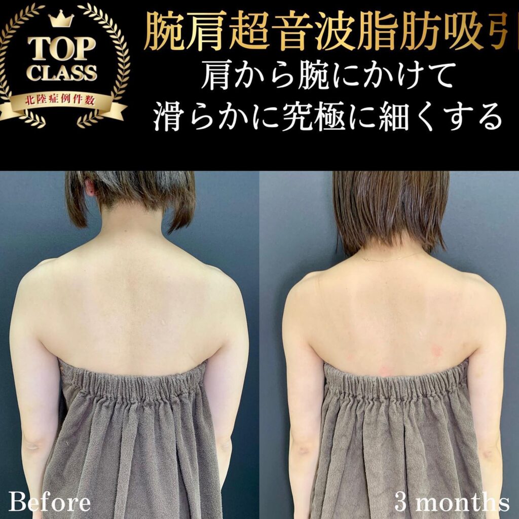 二の腕の脂肪吸引の症例写真