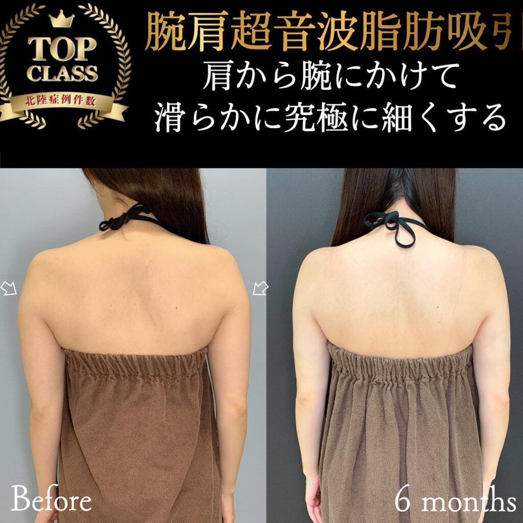 二の腕の脂肪吸引の症例写真
