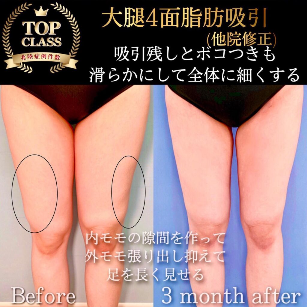 太ももの脂肪吸引の症例写真