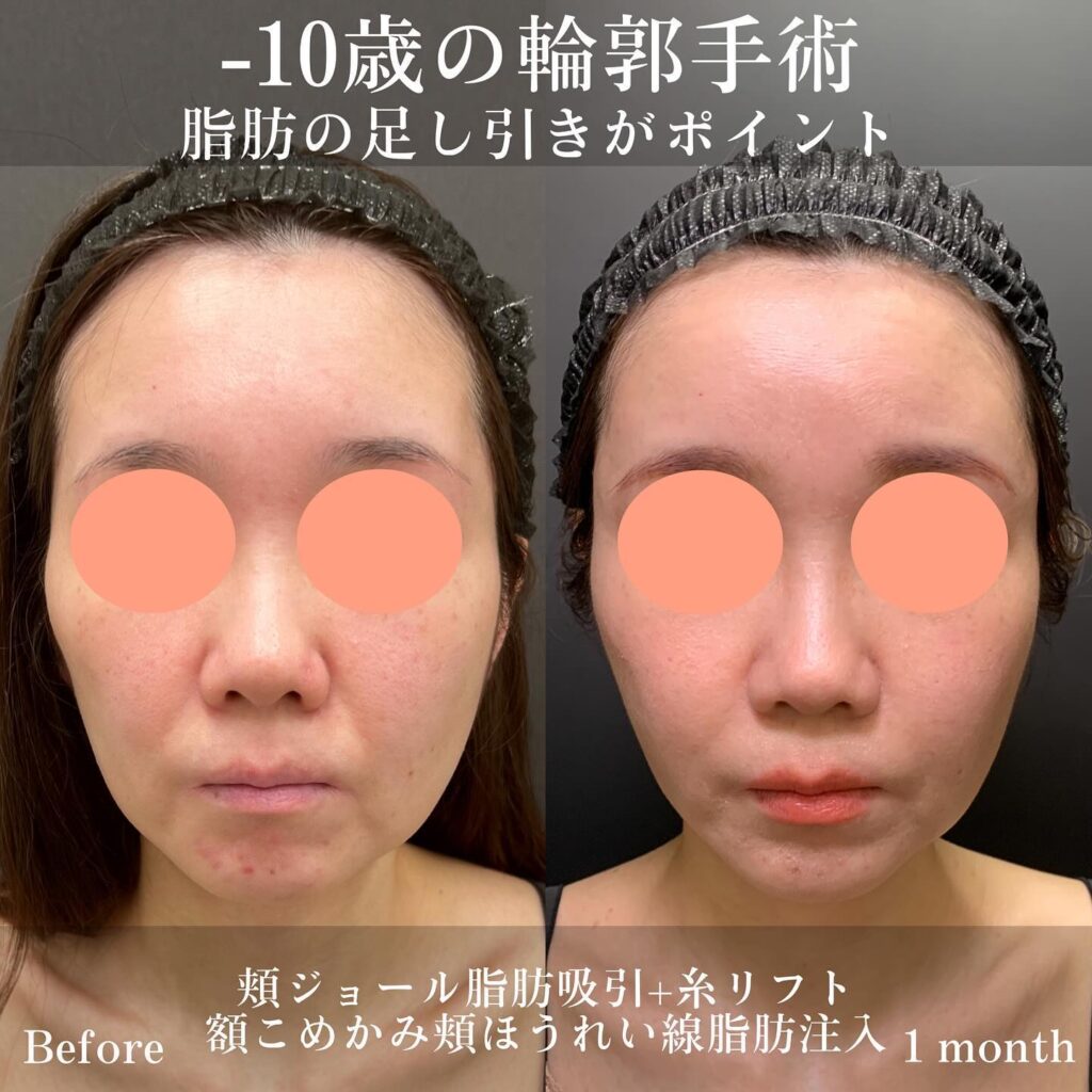 ジョールファットとメーラーファットとバッカルファットと糸リフトと脂肪注入の症例写真 (2)