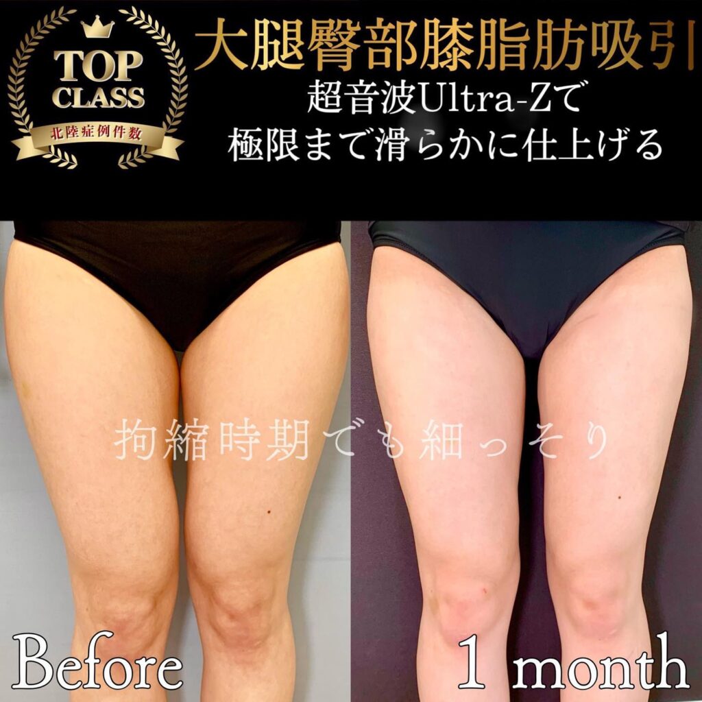 太ももの脂肪吸引の症例写真