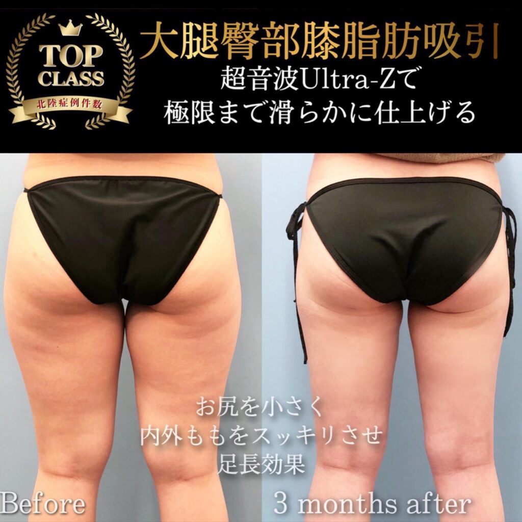 太ももの脂肪吸引の症例写真