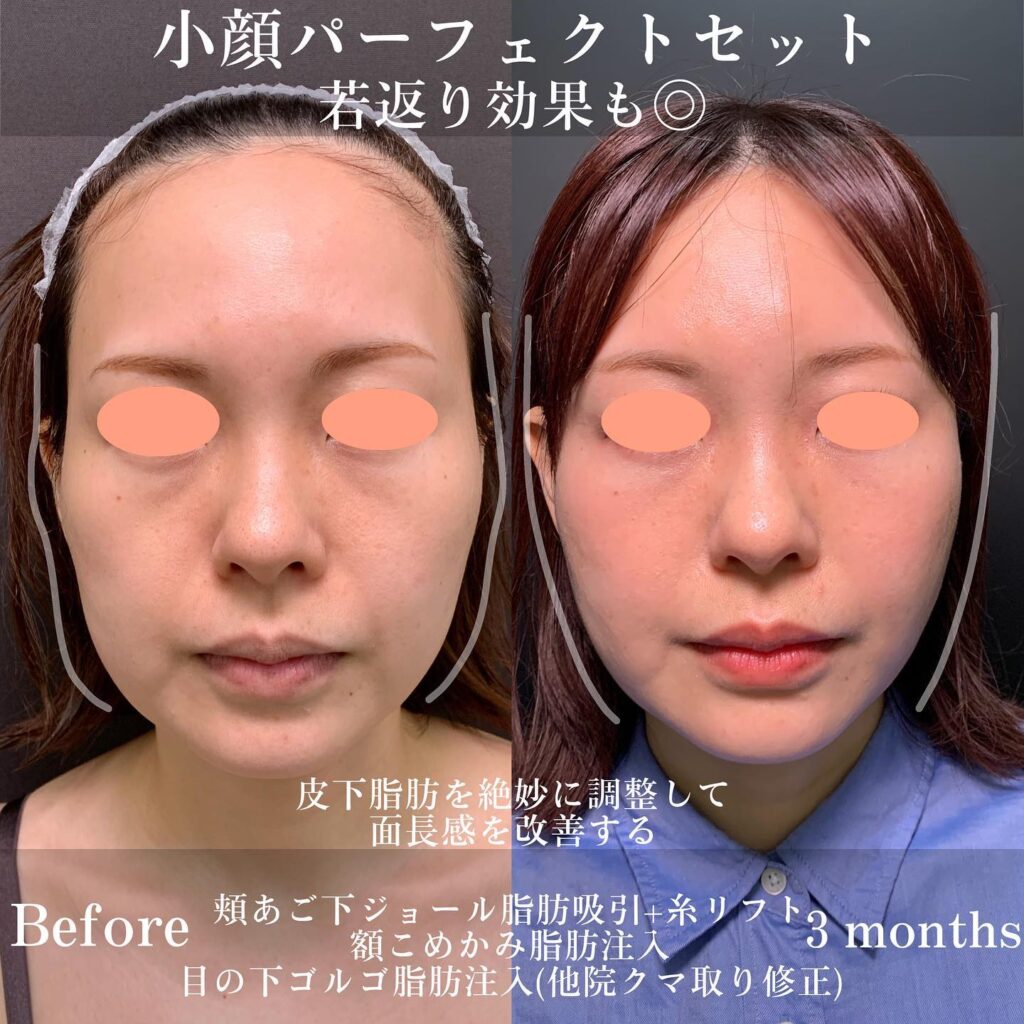 ジョールファットと糸リフトと脂肪注入とクマ取りの症例写真 (2)
