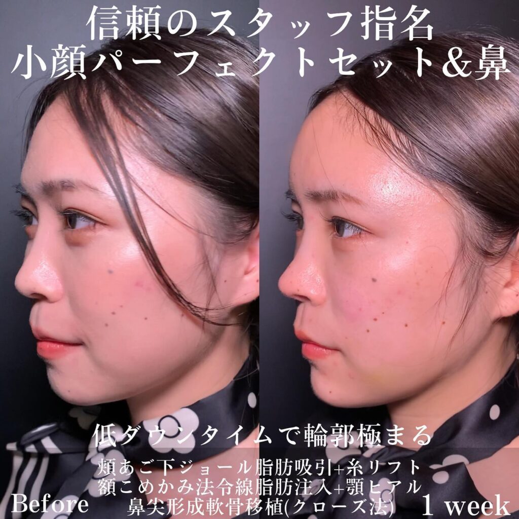 ジョールファットと糸リフトと脂肪注入と顎のヒアルロン酸と鼻尖形成の症例写真 (2)