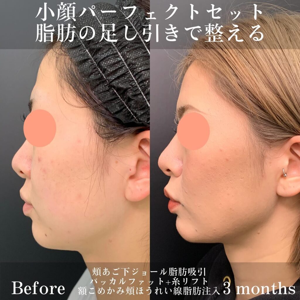 ジョールファットとバッカルファットと糸リフトと脂肪注入の症例写真 (1)