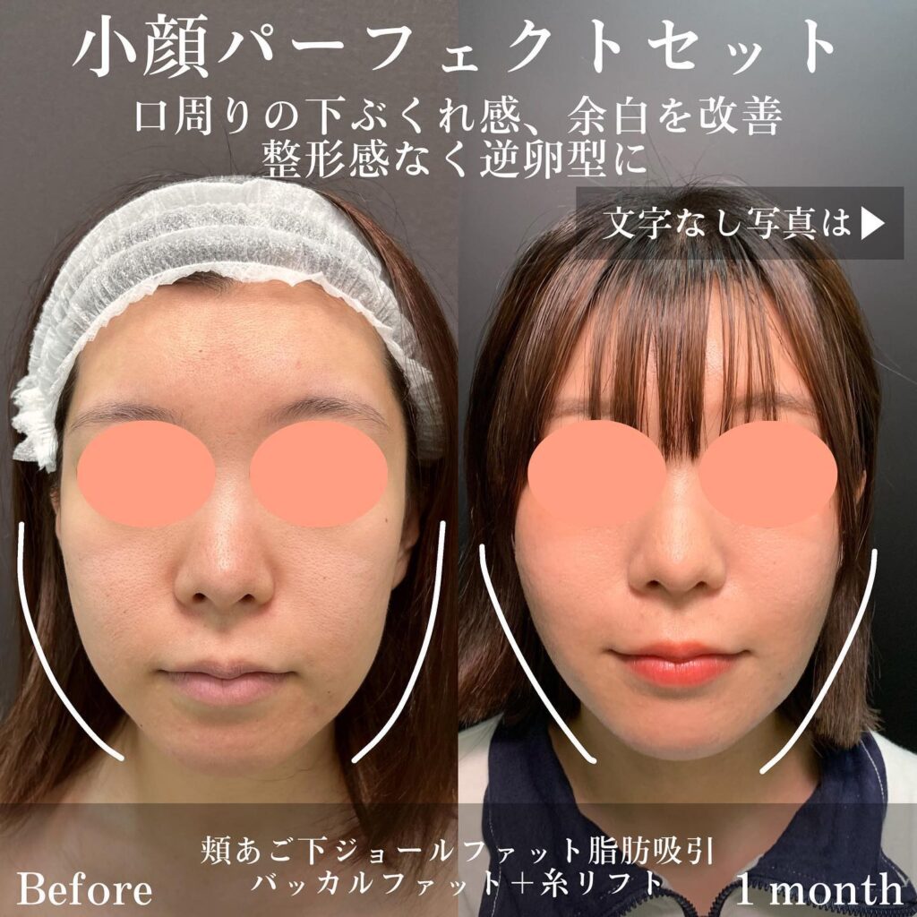 ジョールファットとメーラーファットとバッカルファットと糸リフトと脂肪注入の症例写真