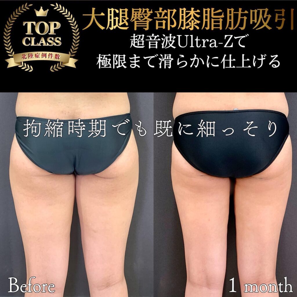 太ももの脂肪吸引の症例写真